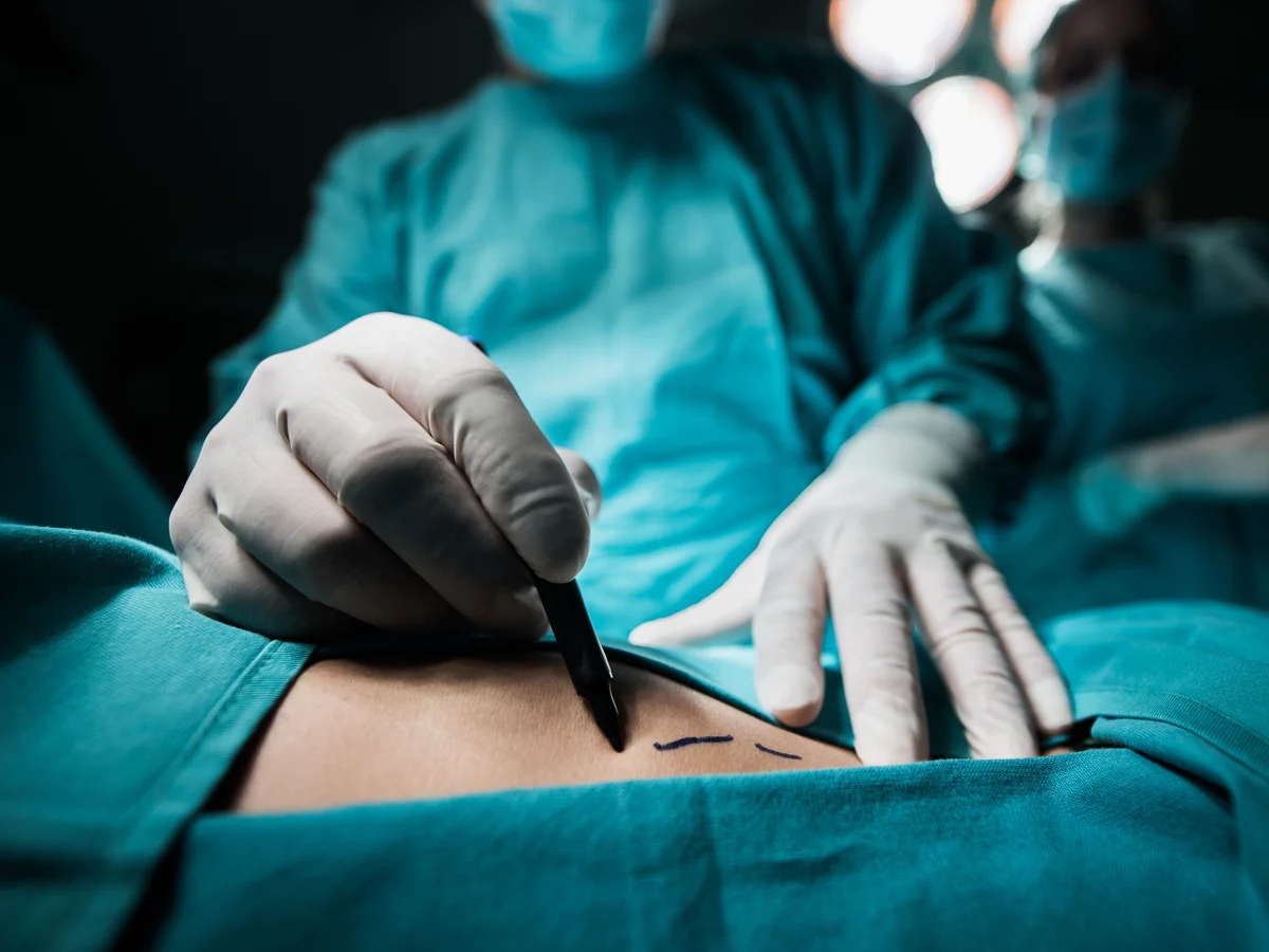 Equipe de cirurgiões em plena cirurgia dentro de sala de operações hospitalar moderna, profissionais vestindo aventais e toucas cirúrgicas azuis, máscaras e luvas estéreis, concentrados ao redor da mesa cirúrgica sob o foco intenso do refletor cirúrgico acima, instrumentos cirúrgicos cromados sobre bandeja estéril em primeiro plano, monitores médicos exibindo sinais vitais ao fundo, ambiente clínico imaculado em tons de azul, branco e aço inoxidável, iluminação fria e dramática, atmosfera de alta precisão e tensão profissional, fotografia médica ultra-realista em alta definição
