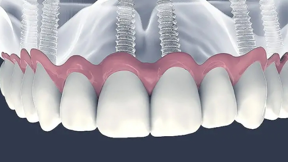 Prótese protocolo sobre implantes, arcada dentária completa em acrílico e porcelana de alta qualidade, fixação em barra metálica, acabamento impecável e natural, fotografia técnica odontológica profissional, fundo neutro bege, iluminação dramática lateral, composição que destaca a sofisticação do tratamento