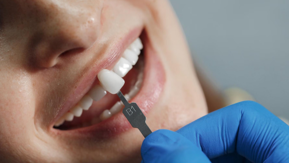 Detalhe de facetas dentárias em porcelana, acabamento impecável e natural, tonalidade perfeita, reflexo suave de luz sobre a superfície cerâmica, fundo neutro bege claro, fotografia macro odontológica profissional, textura realista, composição artística sofisticada